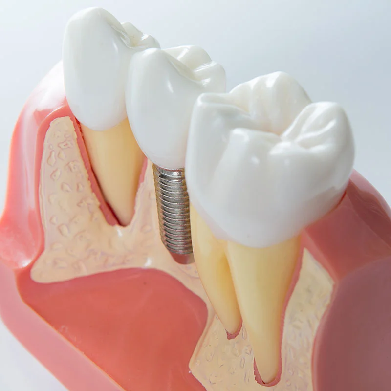 High Standard Dental Implant