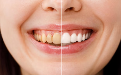The Benefits of Teeth Whitening