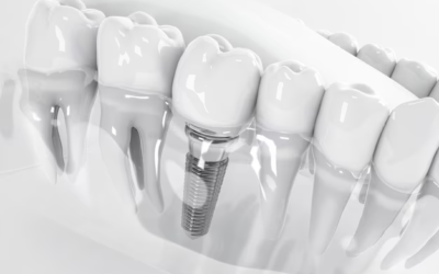 The Wonders of Dental Implants