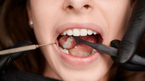 Understanding Oral Cancer: Causes, Effects, and Treatments